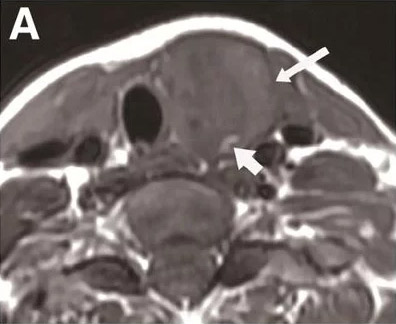 Thyroid gland